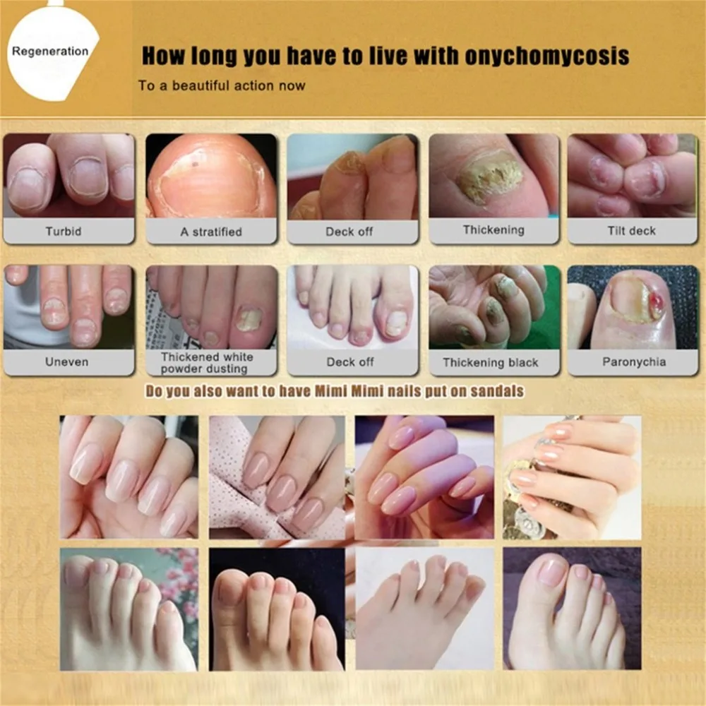 Fungal Nail Treatment Essence Oil Feet Care Nail Art Tools Makeup Polish Tool Nail Gel Armor Essence Toe Fungus Removal 30ml Hot Fungal Nail Treatment Essence Oil Feet Care Nail Art Tools Makeup Polish Tool Nail Gel Armor Essence Toe Fungus Removal 30ml Hot