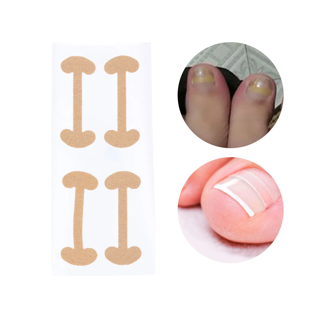 

8Pcs Ingrown Toenail Corrector Stickers Paronychia Treatment Recover Corrector Pedicure Tools Fingernail Toe Nail Care Stickers