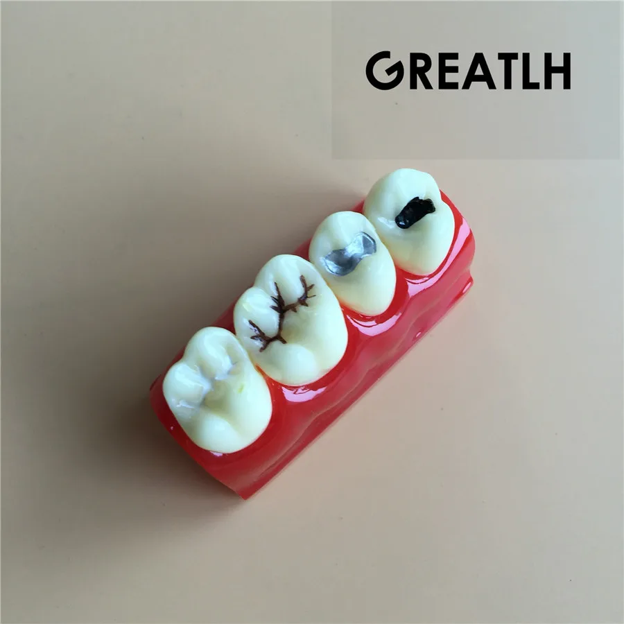 

Dental Caries model Treatment for sealant and lnlay demonstration model Dentist Patient Communication Model