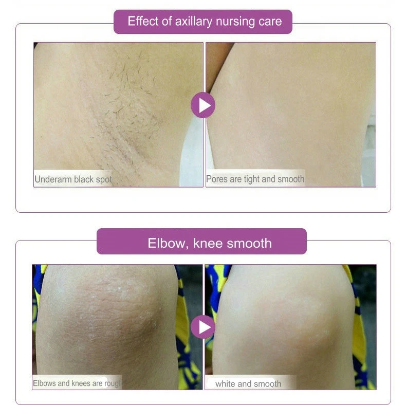 dark inner thighs treatment cream