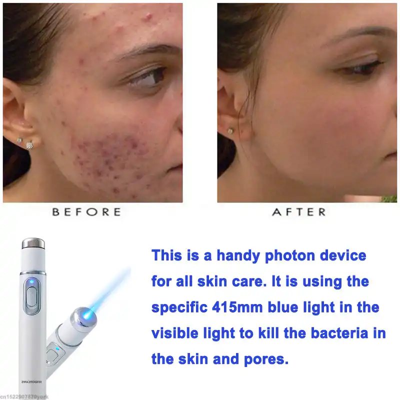 varicose veins on face varicose veins on face