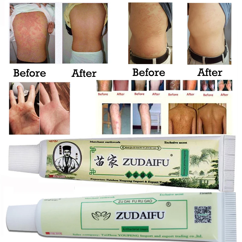 eczema treatment cream in pakistan