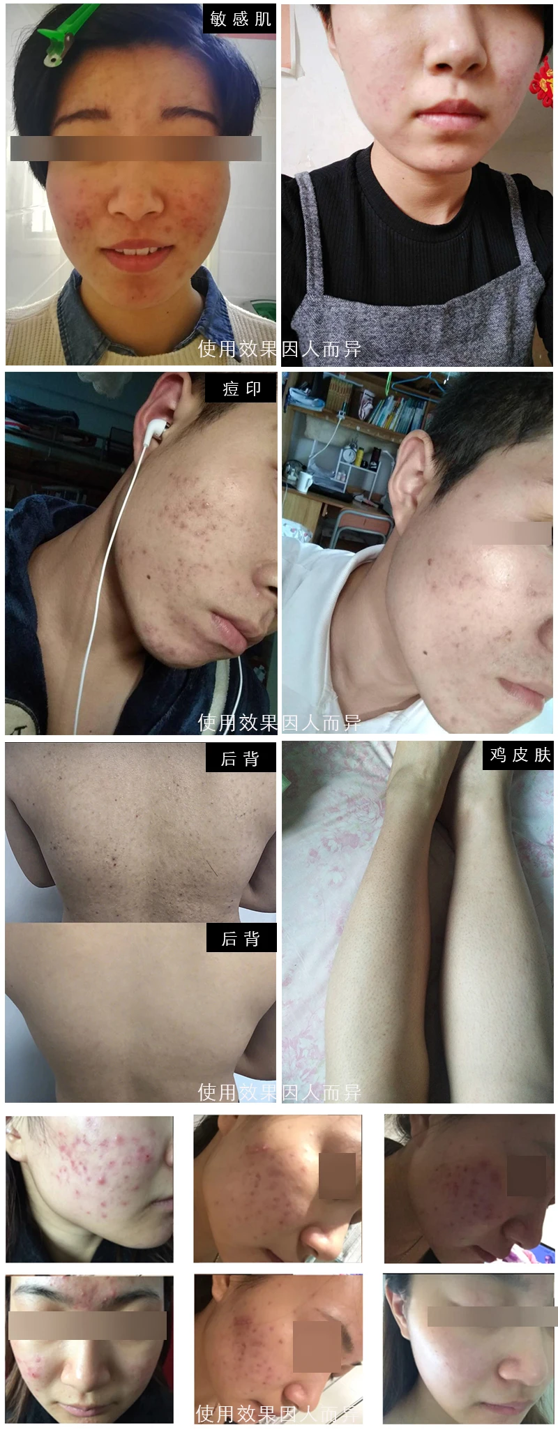 bha esfoliante facial cleaner cravo acne pimple remover remendo acne creme