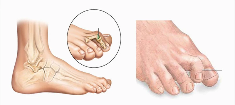 10 пар Силиконовый Уход за ногами Гель ортопедический Almofada кольца разделители ног Soletta исправление шишки на ноге Ортодонтические колодки для обуви