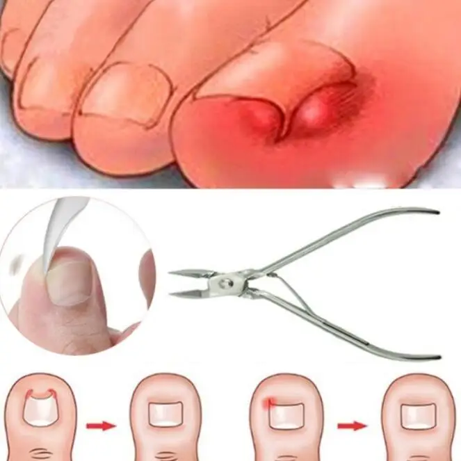Педикюрные инструменты профессиональный вросший носок коррекция ногтей кусачки клипер резак мертвой кожи удаления грязи+ Paronychia педикюр
