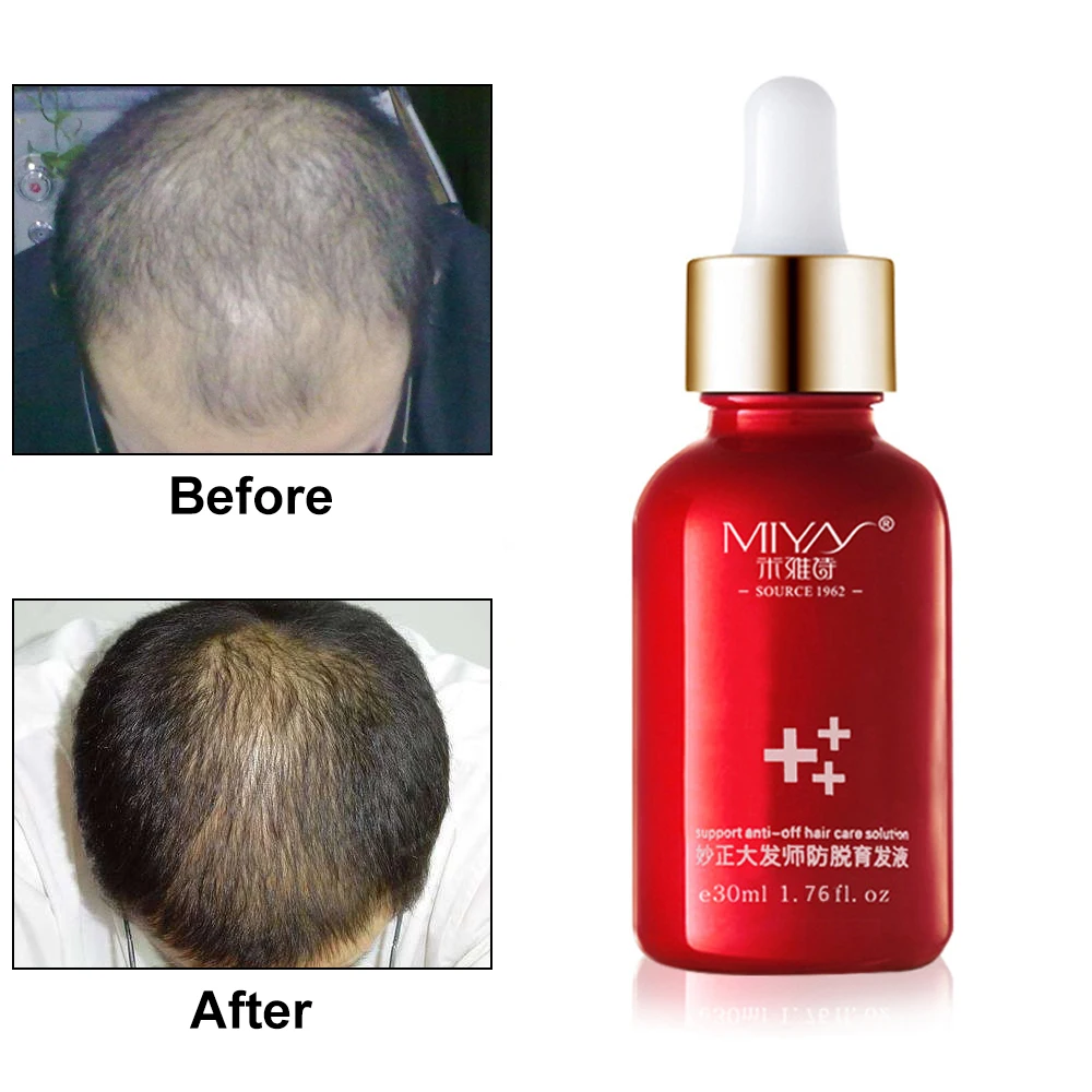 

Fast Powerful Hair Growth Essence Hair Loss Products Essential Oil Liquid Treatment Preventing Hair Loss Hair Care Products 30ml