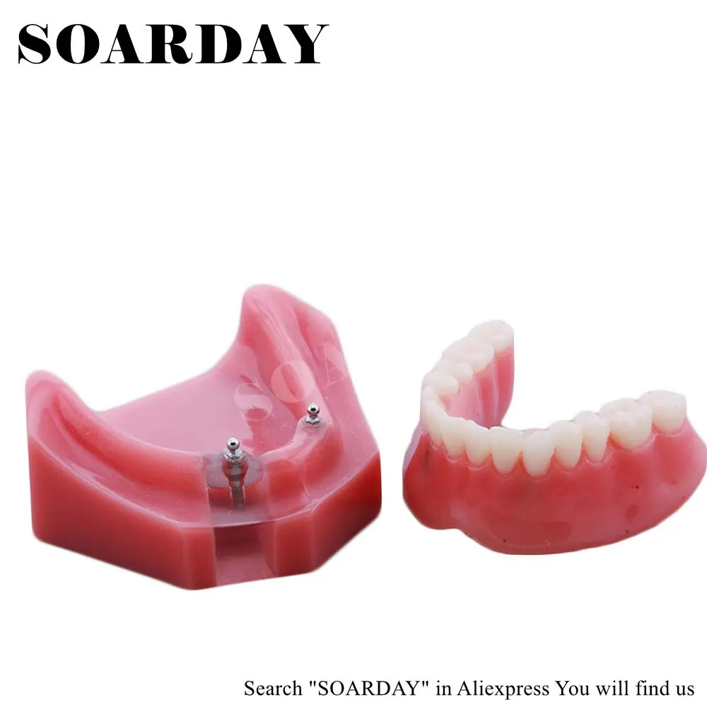 SOARDAY Overdenture уступает с 2 имплантами зубной зуб зубы стоматолог стоматология анатомическая Стоматологическая модель