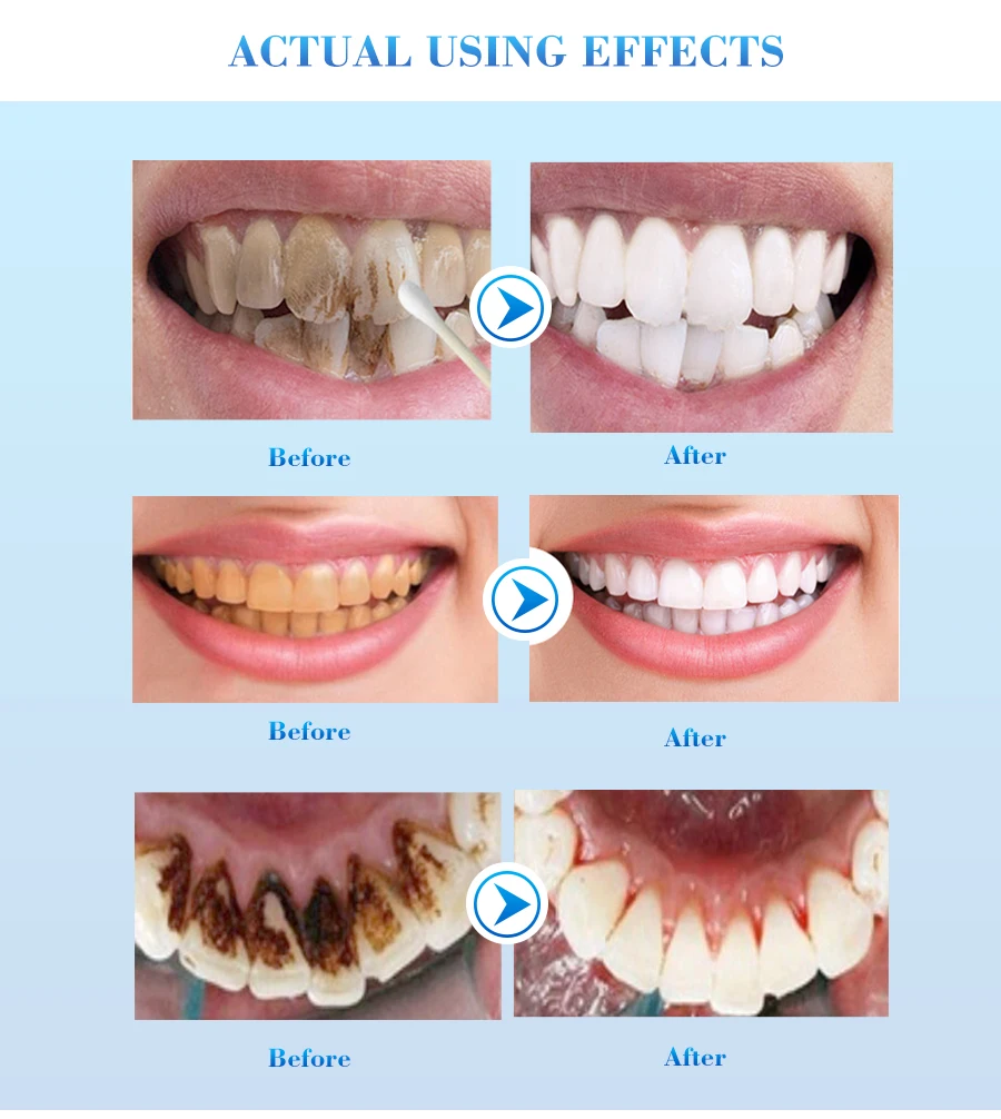 EFERO гигиена полости рта Отбеливание ежедневное использование удаляет зубные Пятна Чистка зубов Отбеливание гигиена полости рта Чистка