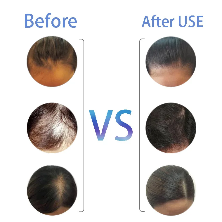 760Laser Hair Growth Comb (2)