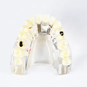 

1 Pc Dental Implant Illustration Teeth Model Detachable for Display M-2006