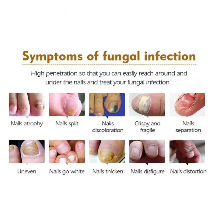 Лечение онихомикоза ногтей рук эссенция противогрибковый Питательный Уход за ногтями OR88