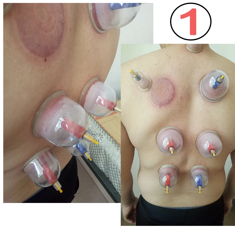 vacuum cupping (12)