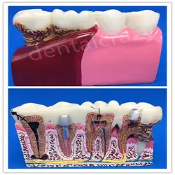 Стоматологические материалы Анатомия кариеса пластиковые зубы модель демонстрация