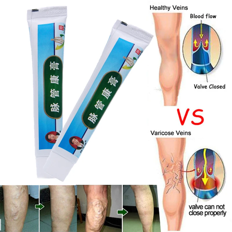 Без коробки! Китайская натуральная травяная медицина для лечения варикозного сосудистого воспаления массажный крем для лечения варикозного расширения вен мазь