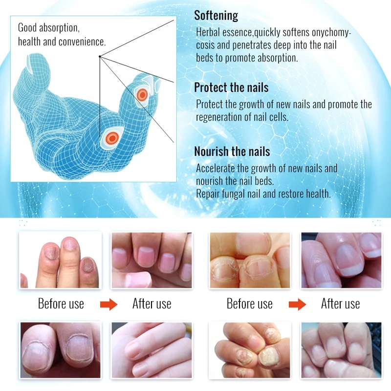 Лечение ногтей от грибка эссенция для ногтей отбеливающий носок удаление грибка гель анти-инфекция Paronychia Onychomycosis