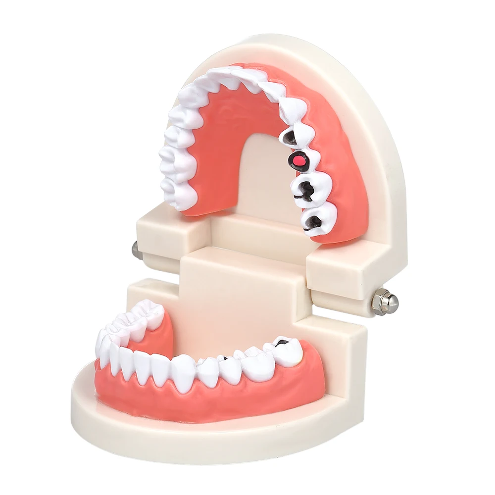 Standard Study Model Big Teeth Model Dental Dentist Tooth Model Disease