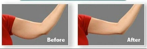 

OPP bag pack Instant arm lift makes arms look firm and younger arm shaping transparent lifting strips sticker AS SEEN ON TV