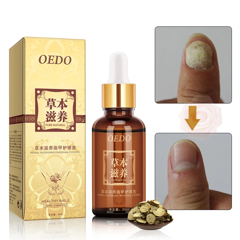 

Useful Nail Fungus Treatment Anti Infection Paronychia Onychomycosis Nail Solution Ringworm Clear Healthy Toenail Growth 30ml