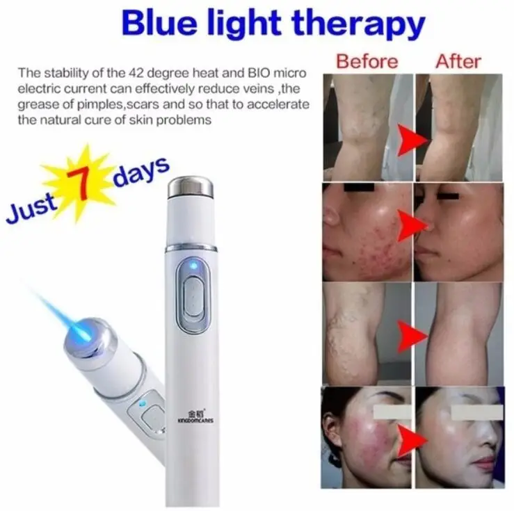Синяя световая лазерная ручка лечение акне удаление морщин шрамов машина терапия ручка Массаж варикозное расширение вен лечение кожи лифтинг инструмент