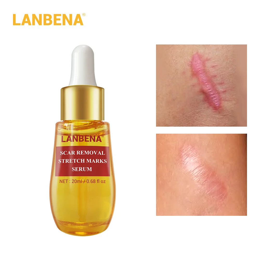 

ANBENA Acne Scar Remove Serum Acne Treatment Remover Stretch Marks Anti Acne Shrink Pores Blackhead Whitening Cream Skin Care