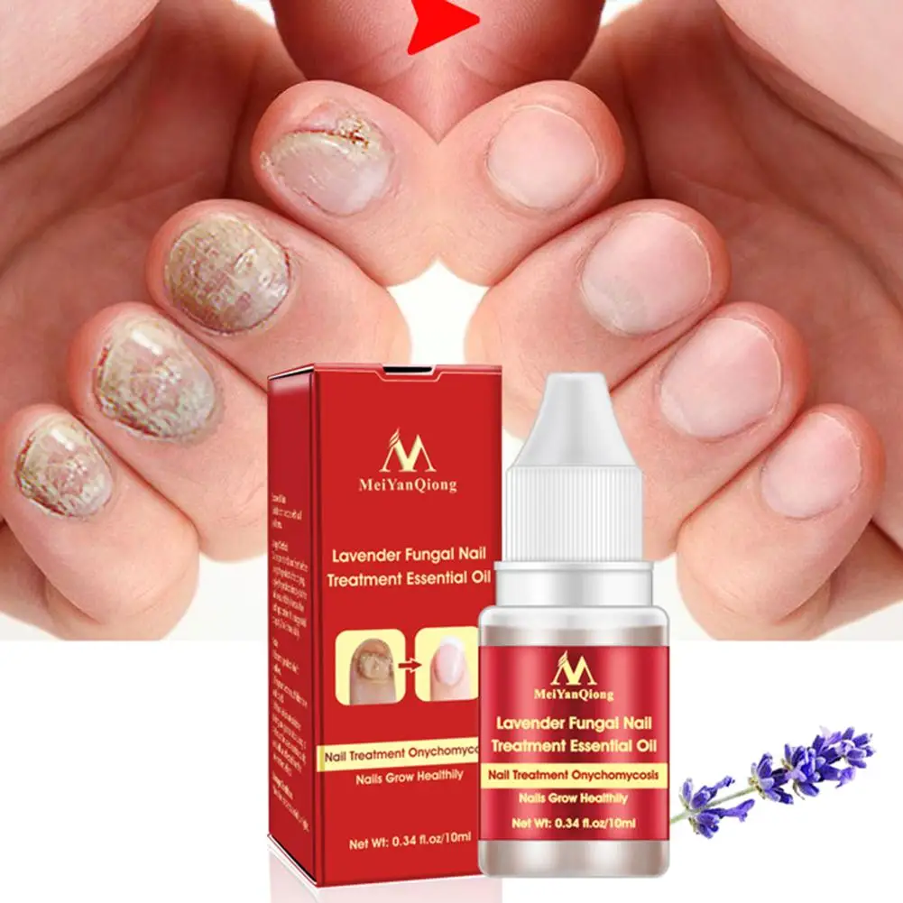 

Fungal Nail Treatment Feet Care Essence Oil Foot/Toe Nail Whitening Fungus Removal Nail Onychomycosis Lavender Essential Oil