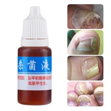 Лечение грибковых ногтей, уход за ногами, эссенция для ногтей, отбеливание ног, удаление грибка ногтей, гель против инфекции, парониксия, онихомикоз