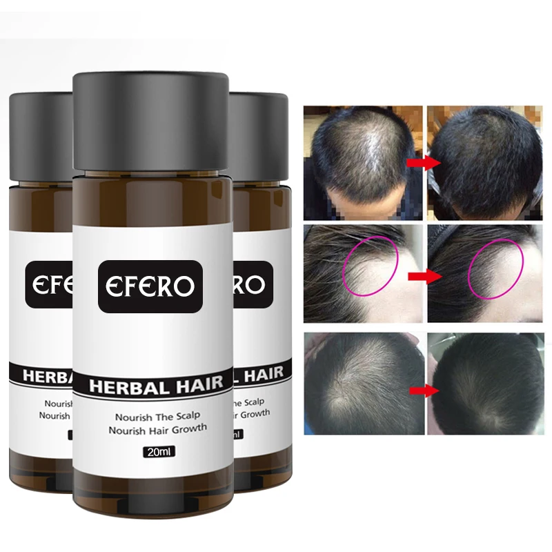 Efero Hair Loss Treatment Serum Essential Oils Dense Hair Growth Serum Hair Care Prevent Baldness Anti-Hair Loss Serum TSLM1