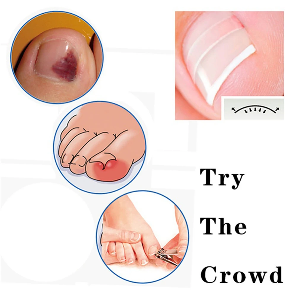 GUJHUI 10Pcs/Box Ingrown Toe Nail Correction Sticker Paronychia Foot Care Treatment