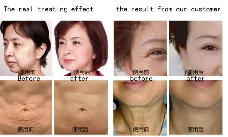 частота лифтинга. микроигольчатый rf infini. частота лифтинга. микроигольчатый rf infini. радиоволновой лифтинг аппарат.