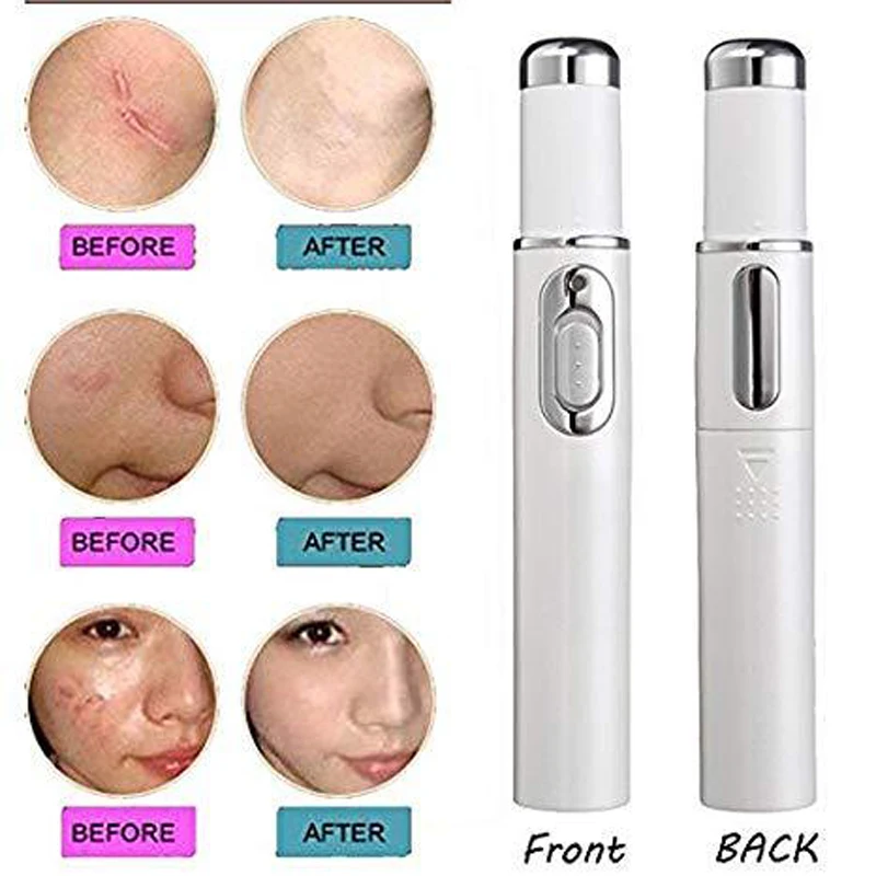 Harga 1 Pcs Medis Cahaya Biru Terapi Varises Perawatan Laser Pena Lembut Scar Kerut Penghapusan Pengobatan Dropshipping