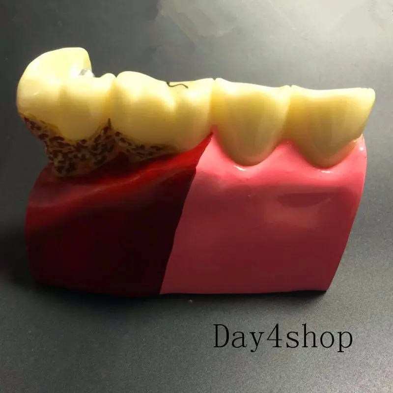 Koop Tandheelkundige Anatomie van cariës plastic tanden model demonstratie communicatie