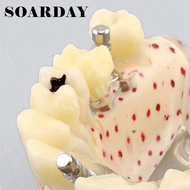 Implant Dental Model for Upper teeth Implant Spongy Bone Carious (3)