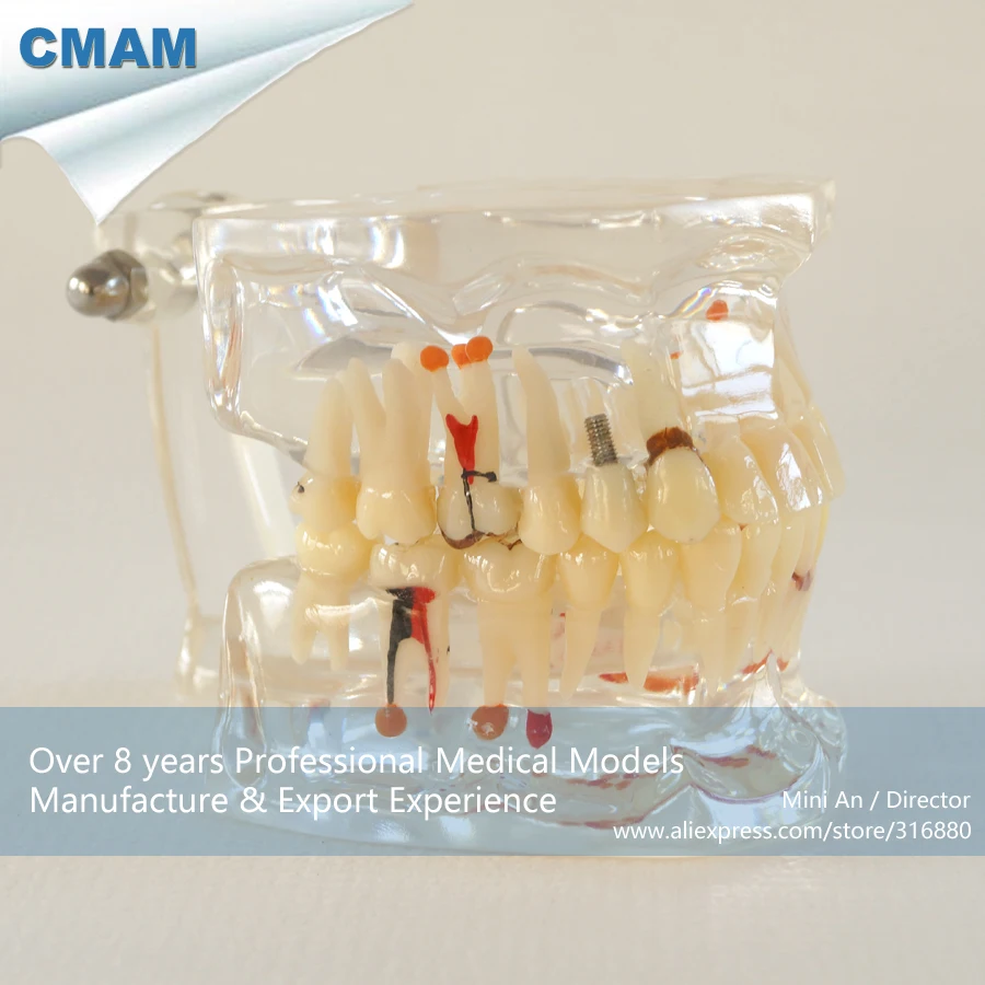 

CMAM-DH301 Adult Jaw Pathology Model with Half Implant for Patient Education