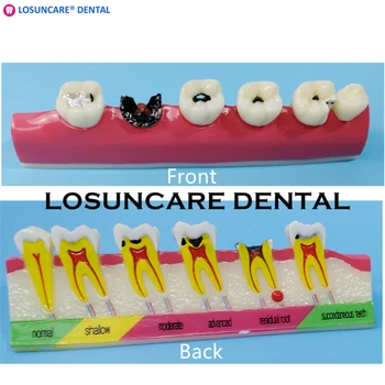 

1PC Dental Denture Teeth Caries Comparison Model Tooth Decay Model Dentist Pathologies For Medical Teaching