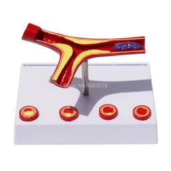 10X Enlarge Human Arterial Coronary Arteriosclerosis Atherosclerosis Coronary Model Cross Section Heart Disease Thrombus Model