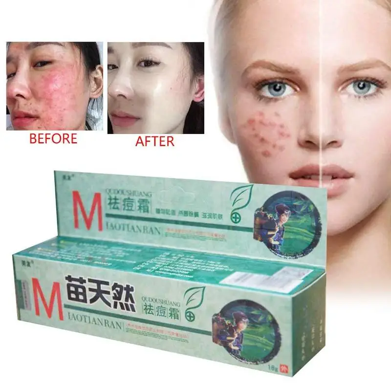 

Original Ointment Fuyou Miaotianran Remove Acne Ointment Cream Germicidal Remove Mite And Moisturize Skin Cream