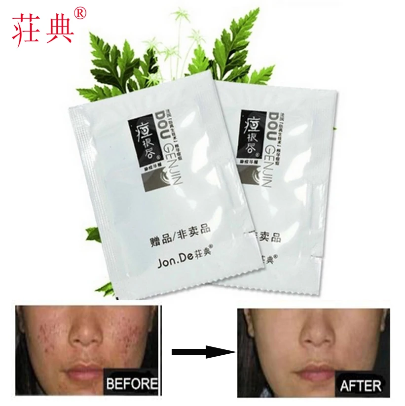 Acne Remover Cream blackhead and comedone acne extractor pimple remover tool oily skin