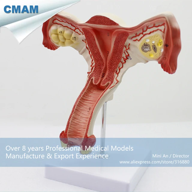 Uterus Pathologie Modell 1:1 - Anatomisches Studienmodell Für Gebärmutter & Eierstöcke