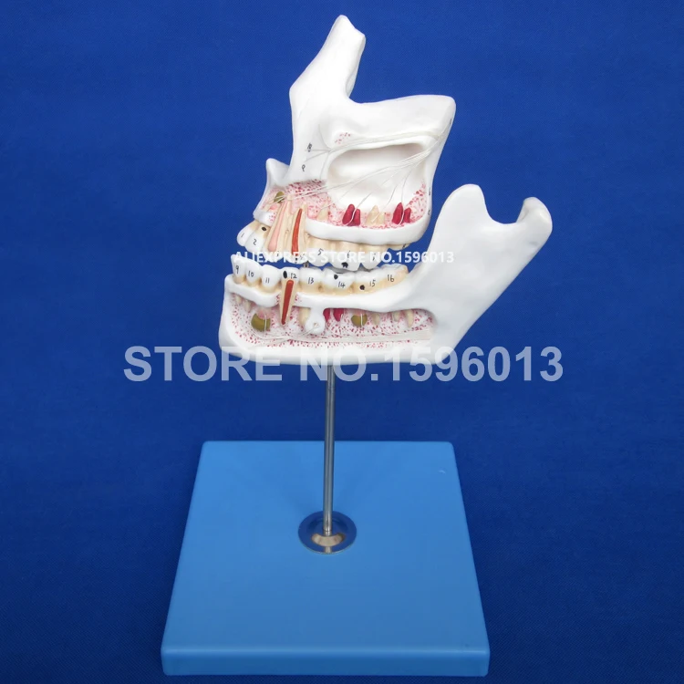 

Pathologic Tooth with Jaw model,Teeth Disease model,Dental Caries,Decayed Teeth and Pulpitis Model