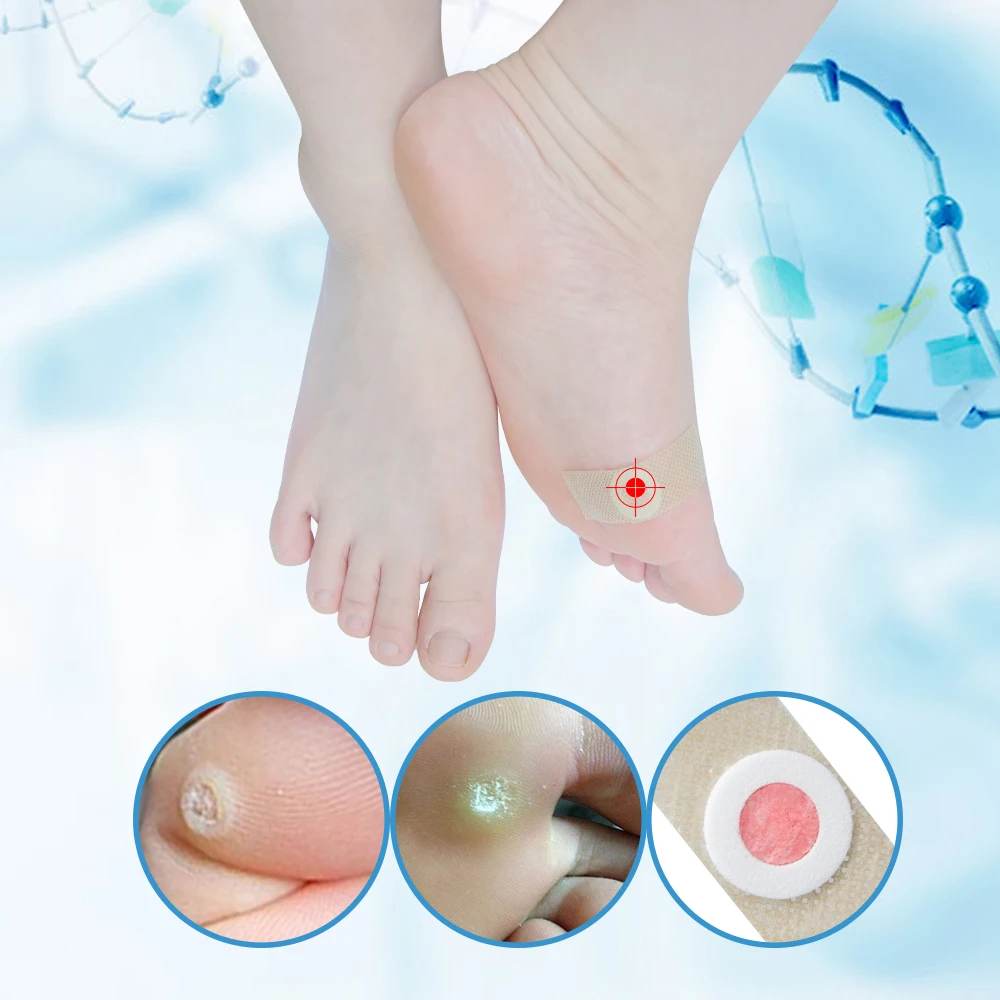 Sumifun 42Pcs Box Foot Corn Removal Plaster Warts Thorn Feet Callus Remove Soften Skin Cutin Sticker 1 Sumifun 42Pcs Box Foot Corn Removal Plaster Warts Thorn Feet Callus Remove Soften Skin Cutin Sticker 3