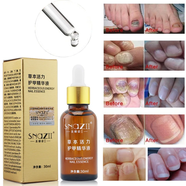 Antifungal oje - onikomikoz için etkili bir tedavi Antifungal oje - onikomikoz için etkili bir tedavi