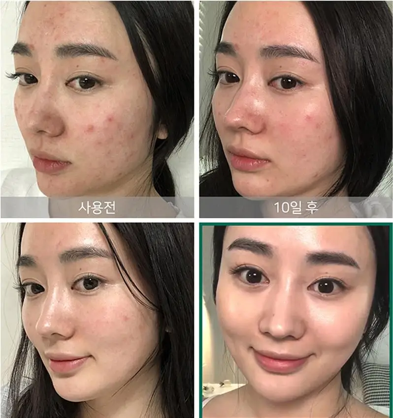 Некоторые MI ана BHA ПГА 30 дней чудо Сыворотки 50 мл уход за кожей лица для лечения