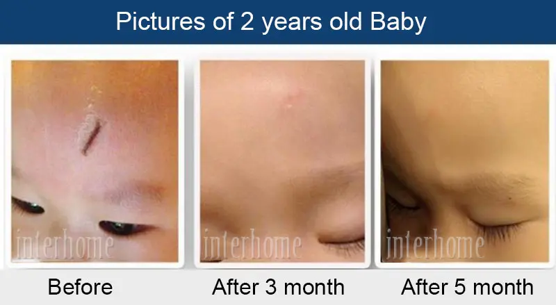 Self-adhesive-silicone-scar-paste(10)