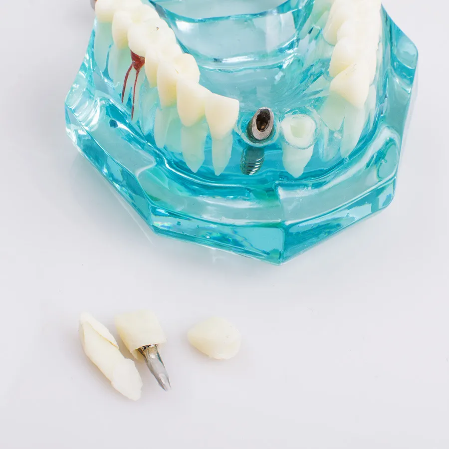 Новый Стоматологическая Исследование зубов Прозрачный взрослых Патологическая зубы модель подходит для взрослых