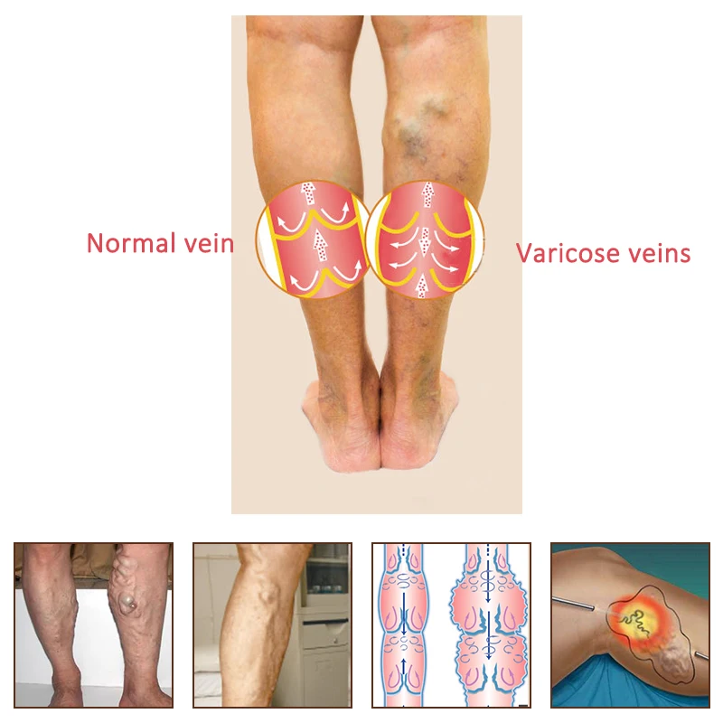 2 упаковки, крем для лечения варикозных вен, васкулит, флебит, удаление вен паука, китайская медицина, средство для удаления варикозного ангиита