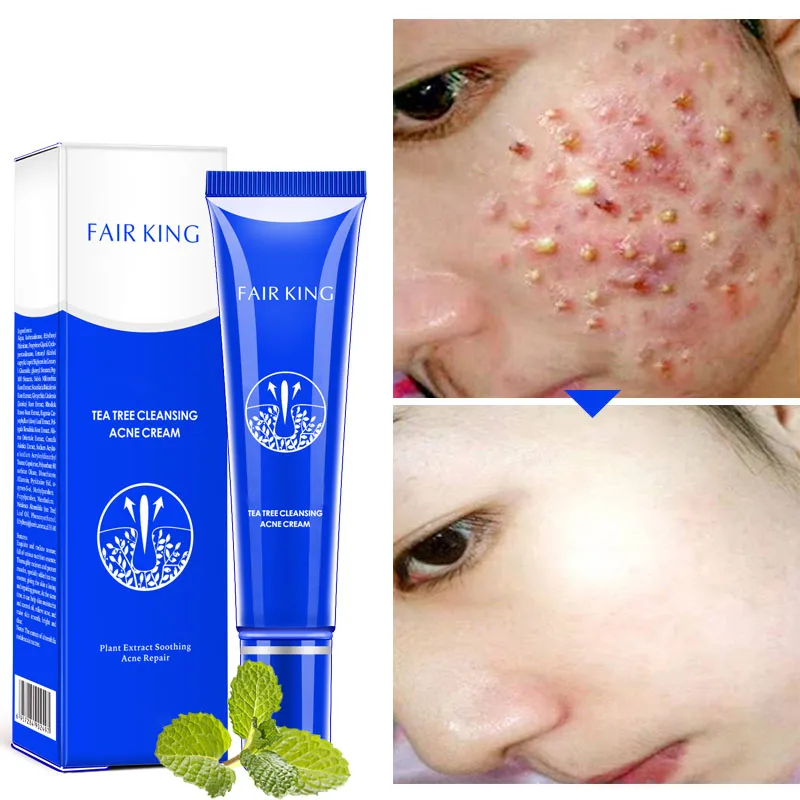 

Cystic Acne Spot Cream Fast Acting Formula Cream for Clearing Severe Acne from Face Body H7JP