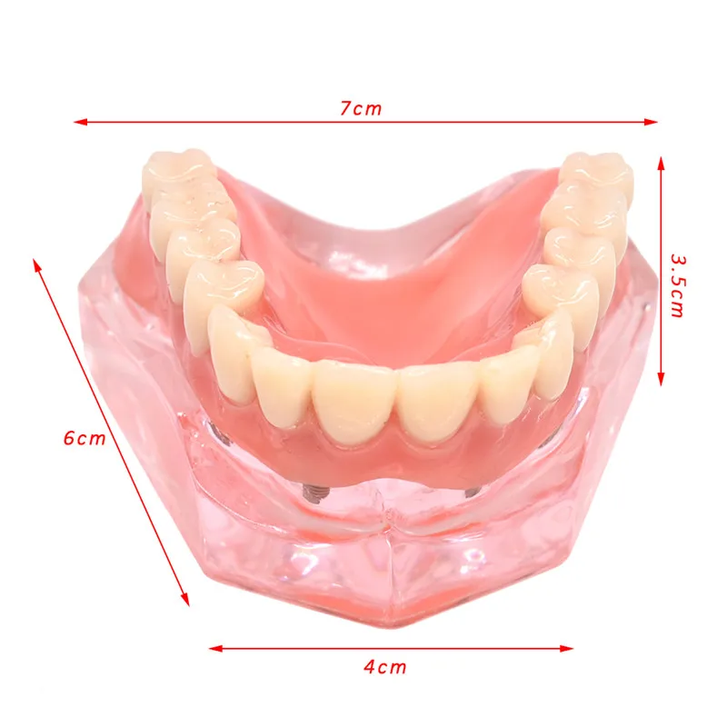 Зубные протезы, модель зубов, съемные внутренние нижние челюсти, модель нижних зубов с имплантатом для обучения зубов