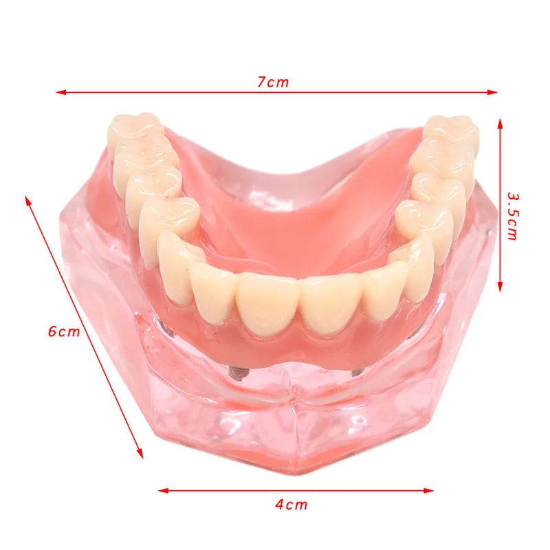 Mandibulares com Implante de Dente Modelo Teeth Dental Overdenture Removível Interior Mandibular Inferior Estudo Ensino Modelo Dentes 9 Dentes dentários dentários modelo interior removível mandibular