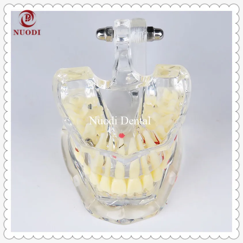 Модель моста зубного имплантата/образовательная модель зубов/со съемным имплантатом crown & abutment/прозрачная для взрослых patological teeth Model
