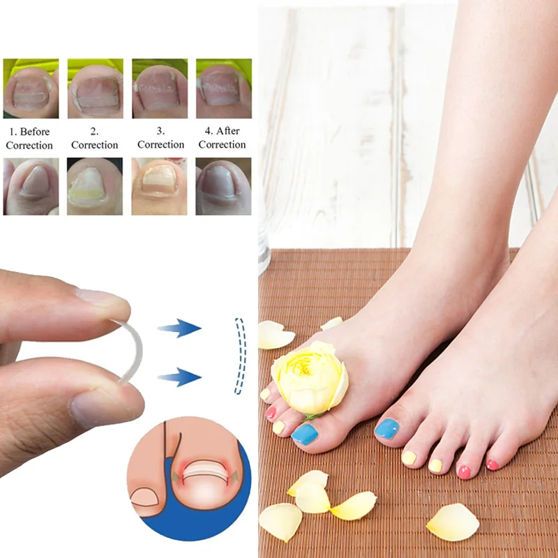 

10pcs Ingrown Toenail Correction Ingrown Toe Nail Treatment Elastic Patch Sticker Straightening Clip Brace Pedicure Tool